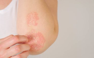 CLOSE UP: Unrecognizable young woman suffering from autoimmune incurable dermatological skin disease called psoriasis. Female gently scratching red, inflamed, scaly rash on elbows. Psoriatic arthritis